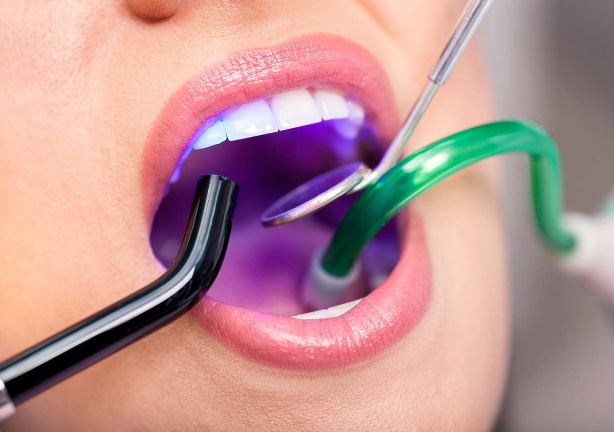 UV healing of dental fillings